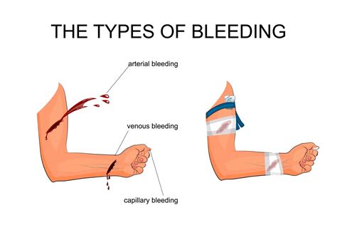 3 Types Of Bleeding And How To Control Them 3 Types Of Bleeding And How To Control Them