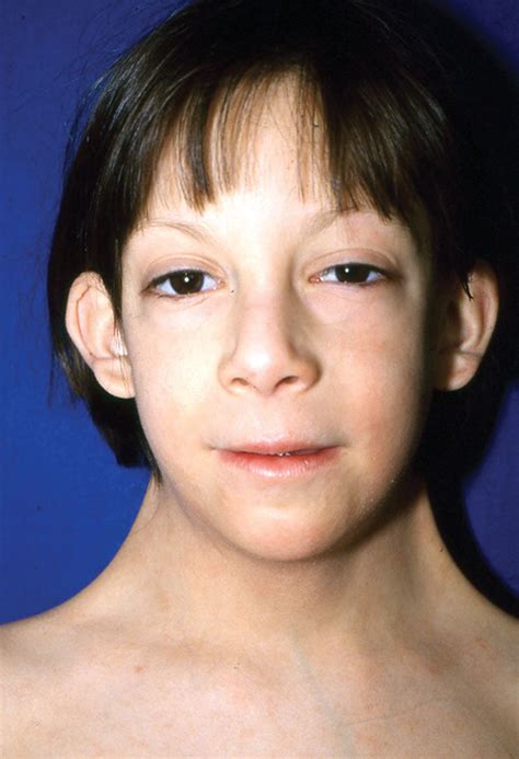 A 7 Year Old Girl With Pterygium Colli Associated With Turner Syndrome Download Scientific Diagram A 7 Year Old Girl With Pterygium Colli Associated With Turner Syndrome Download Scientific Diagram