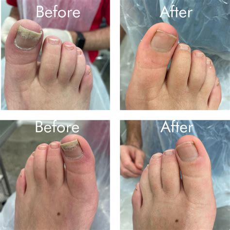 Advance Laser Therapy For Toenail Fungus Top Podiatrist Advance Laser Therapy For Toenail Fungus Top Podiatrist