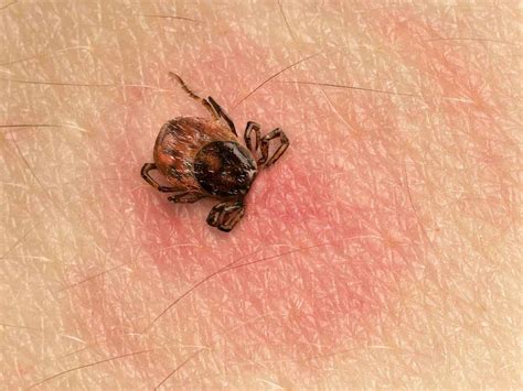 How To Identify Tick Bites Tick Bite Pictures Igenex Tick Talk How To Identify Tick Bites Tick Bite Pictures Igenex Tick Talk