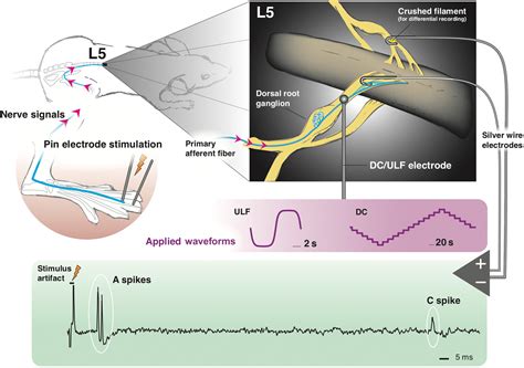 Presidio Medical Raises 72 Million For Ulf Neuromodulation Platform