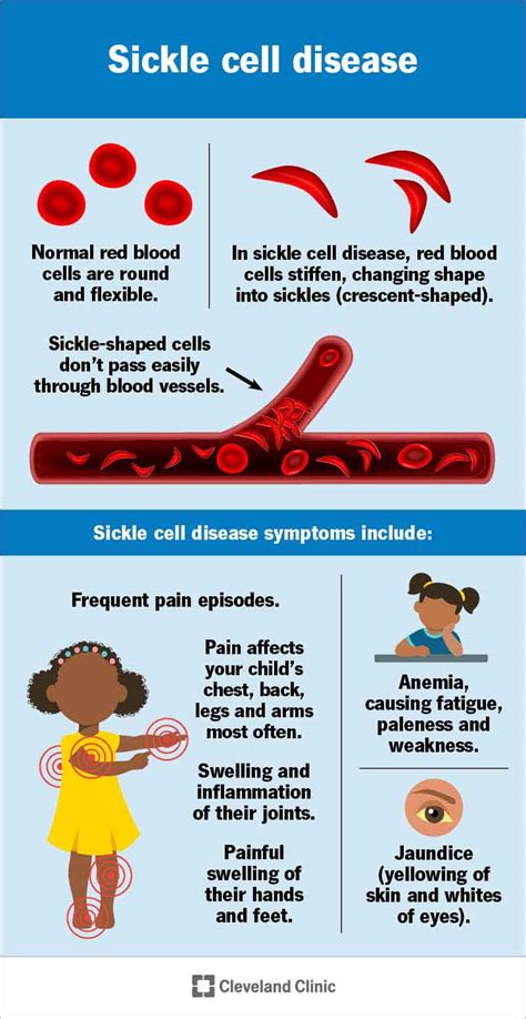 Sickle Cell Disease