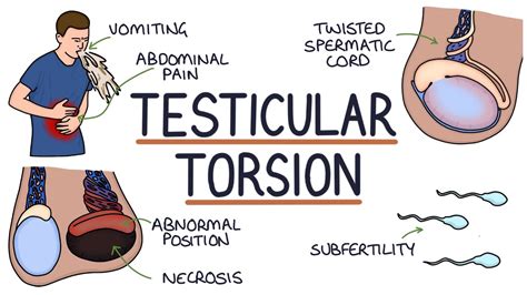 Testicular Torsion Name At Christopher Thorson Blog