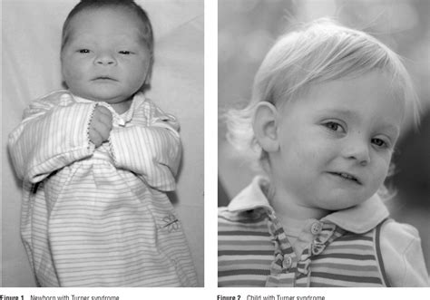 Turner Syndrome An Update And Review For The Primary Pediatrician Semantic Scholar Turner Syndrome An Update And Review For The Primary Pediatrician Semantic Scholar