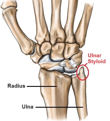 Ulnar Head And Styloid Fractures Clinical Gateclinical Gate