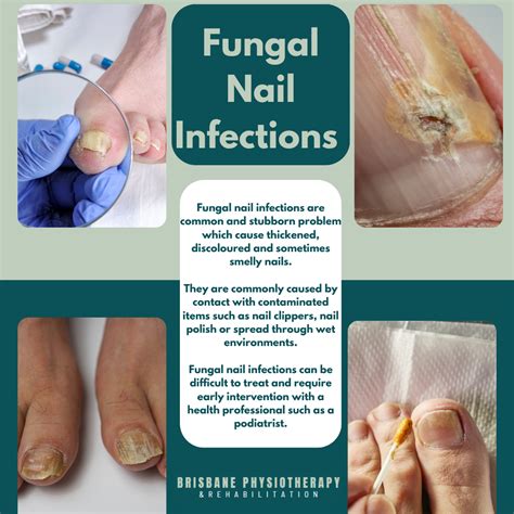 What Causes Fungal Nail Infections Algeos What Causes Fungal Nail Infections Algeos